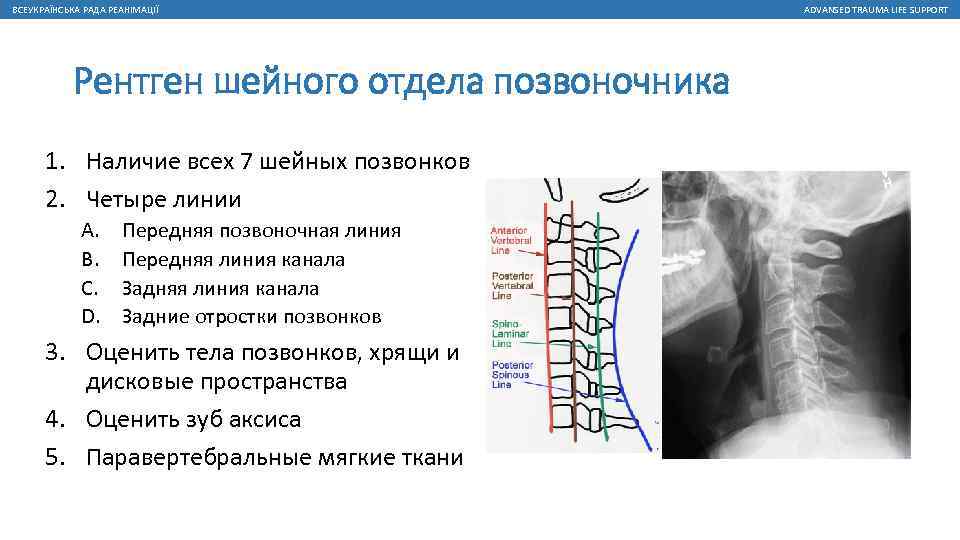 Травма шейного отдела позвоночника - симптомы болезни, профилактика и лечение травмы шейного отдела позвоночника, причины заболевания и его диагностика на eurolab