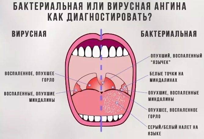 Ангина: особенности, классификация, симптомы