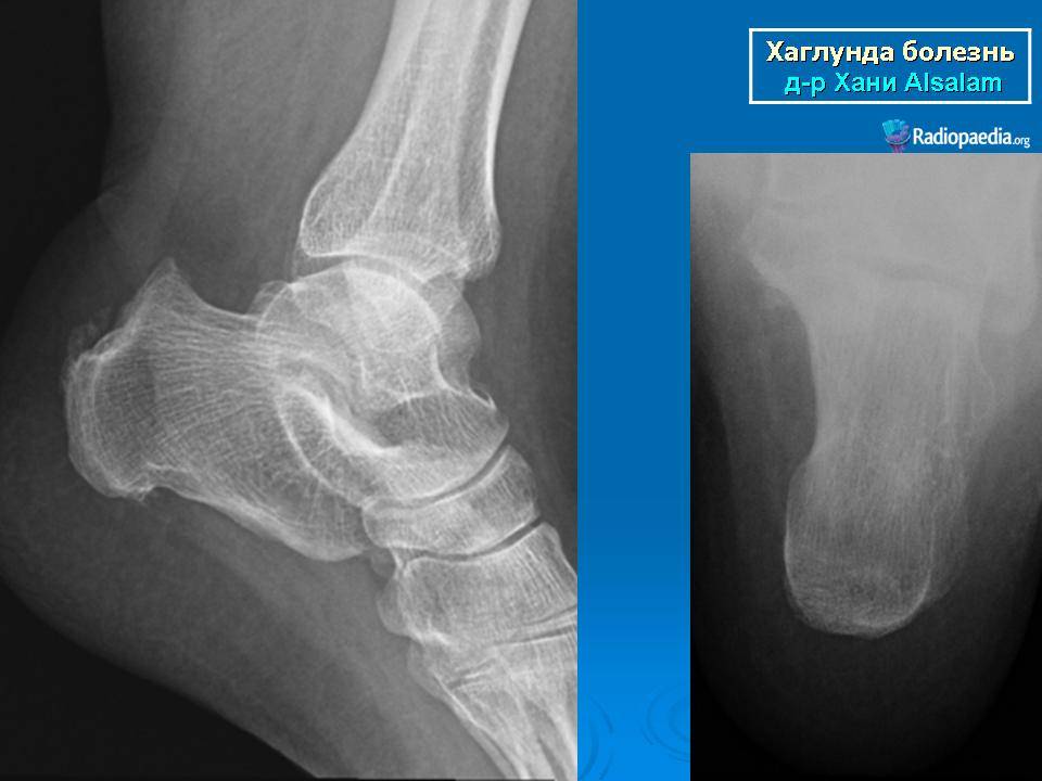 Болезнь шинцу. Болезнь Хаглунда Шинца пяточной кости что это. Болезнь Хаглунда-Шинца остеохондропатия. Остеохондропатия Шинца рентген. Остеохондропатия пяточной кости Хаглунда Шинца.