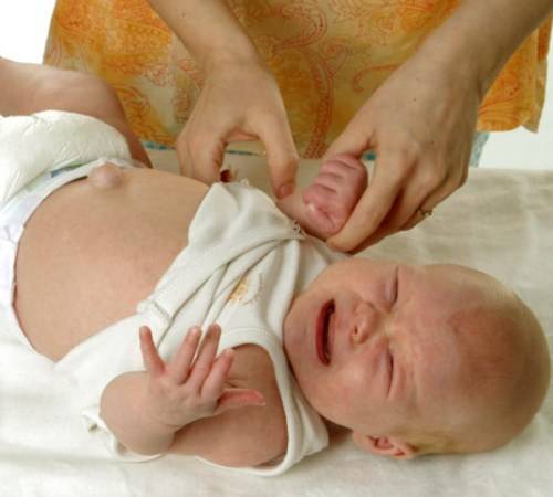 Техника и эффективность массажа при пупочной грыже у новорожденных - proinfospine