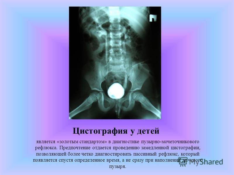 Рентгенография мочевого пузыря (цистография) - цена, сделать рентген мочевого пузыря в клинике «мать и дитя» в москве