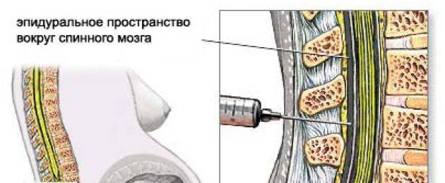 Причины боли в спине после эпидуральной анестезии? — med-anketa.ru