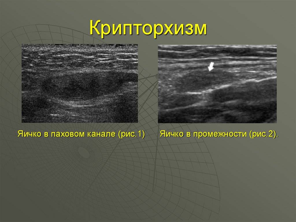 Эпидидимит: лечим воспаление придатков яичка у мужчин | клиника лазерных технологий medcity.ua