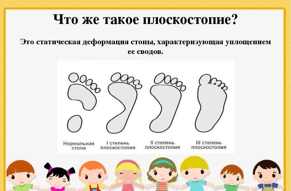 7 видов плоскостопия у детей и взрослых: симптомы и профилактика - блог стельки.ру