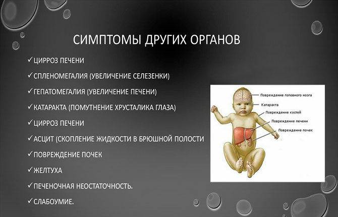 Случай галактоземии у новорожденного ребенка с низкой массой тела | кравченко | медицинский вестник юга россии