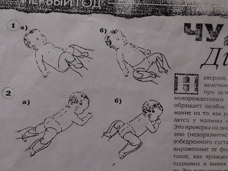 Гимнастика при дисплазии тазобедренных суставов у детей: видео лфк для новорожденных и малышей до года
