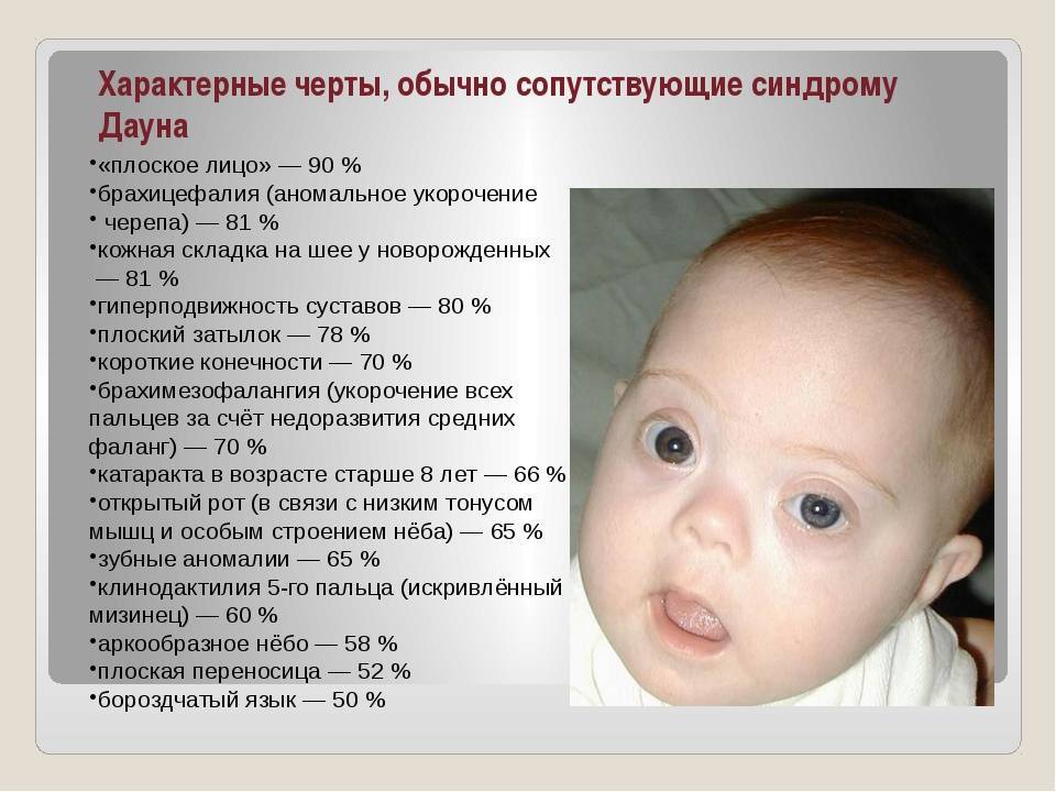 Синдром дауна: признаки, причины, диагностика — online-diagnos.ru