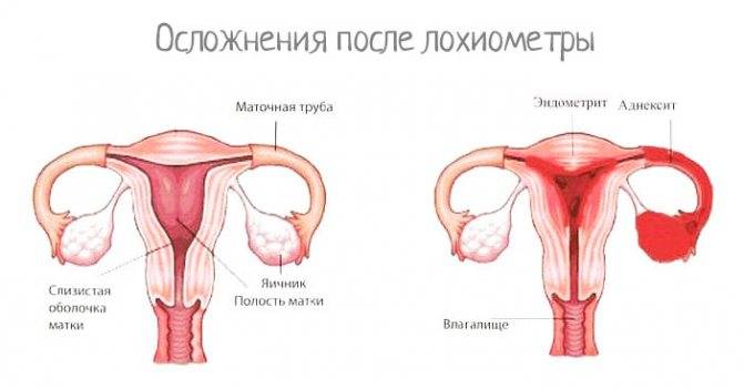 Лохиометра это. Послеродовой эндометрит матка. Эндометрит гинекология.