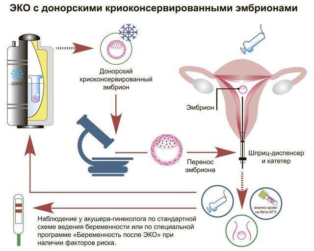 Перенос эмбрионов при эко - процедура переноса замороженных эмбрионов после криоконсервации в gms эко