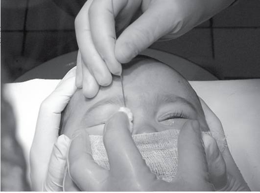 Мануал для родителей по проведению массажа слёзного канала у новорождённых, рекомендованный педиатром