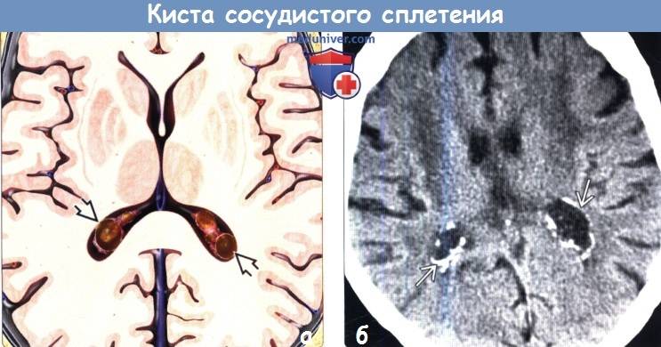Киста головного мозга у взрослого, ребенка, новорожденного. симптомы и лечение, чем опасна киста в голове - medside.ru