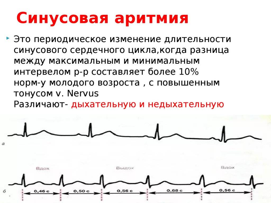Расшифровка экг: наиболее важные показатели кардиограммы с примерами нарушений | университетская клиника
