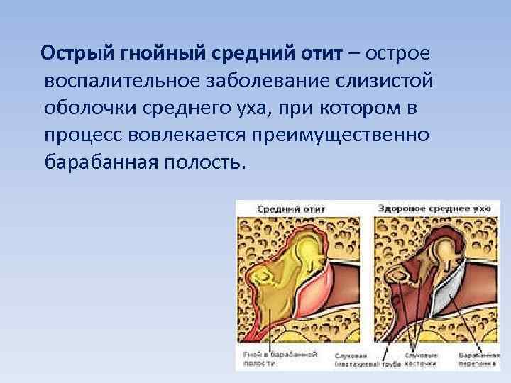 Лечение отита, симптомы хронического воспаления острого среднего уха у взрослых, лекарства