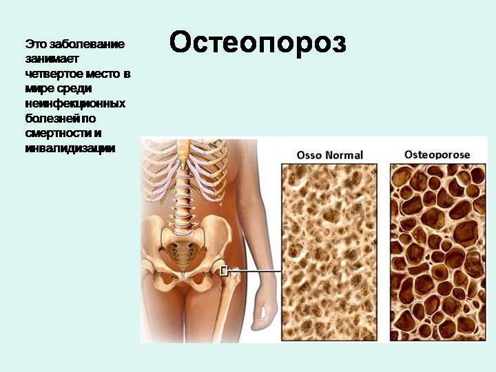 Остеопороз суставов: лечение, симптомы, виды