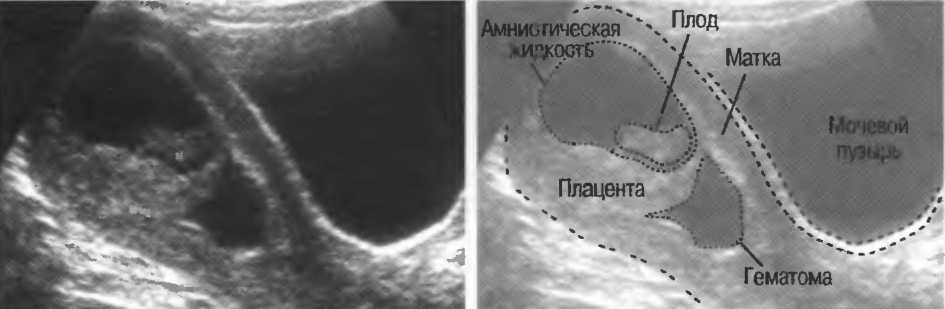 Гематома при беременности. Ретроплацентарная гематома. Ретрохориальная- субамниотическая гематома. Ретрохориальная гематома при беременности на ранних.