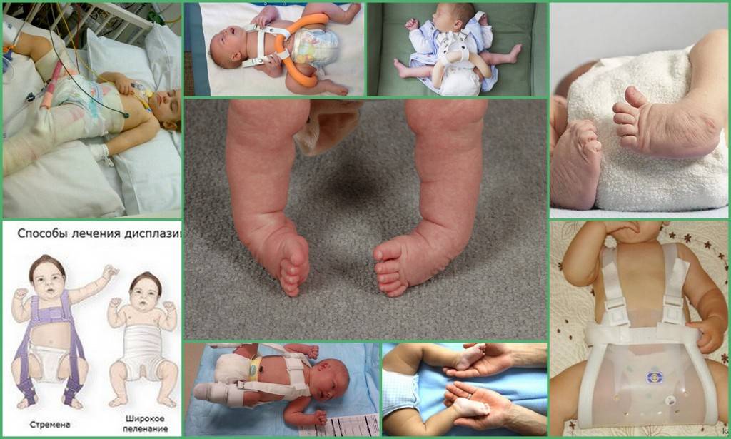 Дисплазия тазобедренных суставов у младенца