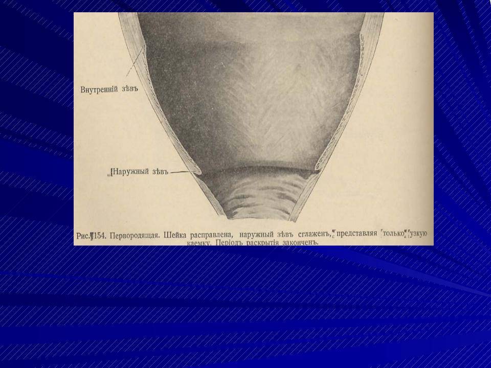 Полип шейки матки (цервикальный полипоз) – причины заболевания, профилактика и лечение