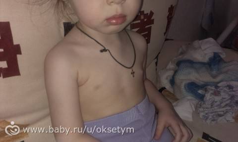 Телархе у девочек 1 года: причины, диагностика, лечение, видео - rdbkomi.ru