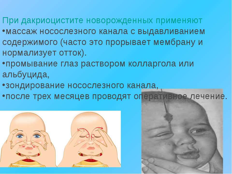 Непроходимость носослезного канала у детей