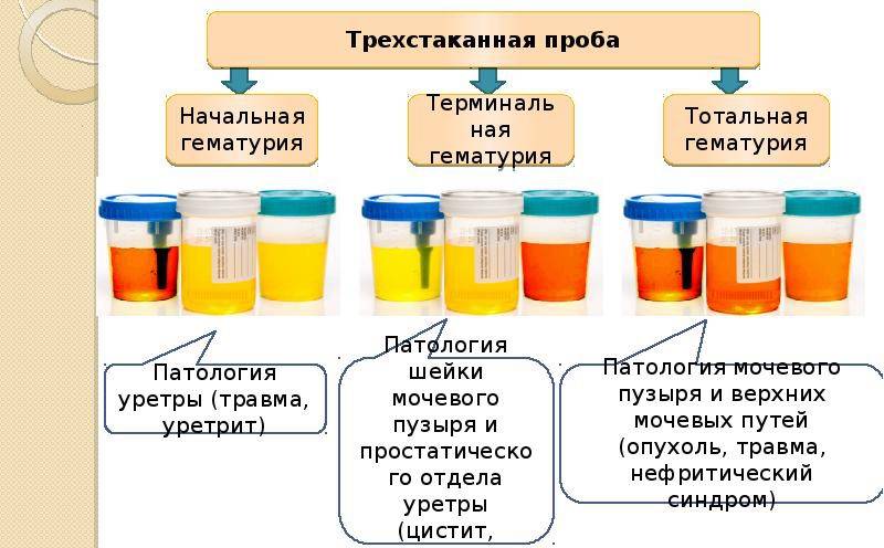 Кровь в моче (гематурия) у женщины, у мужчины.