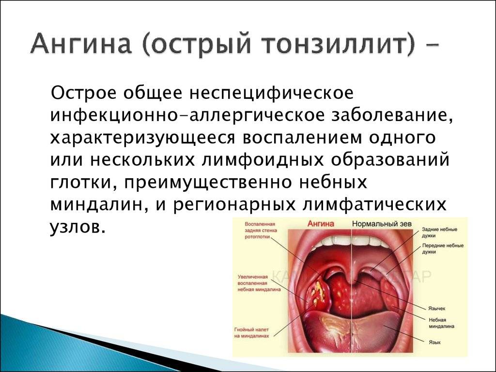 Ангина вирусная и бактериальная — (клиники di центр)