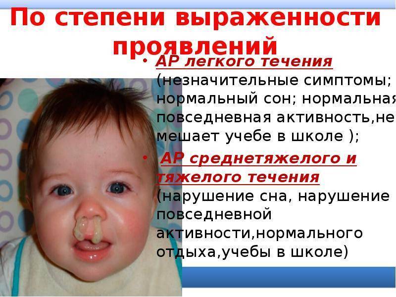 Симптомы аллергического ринита