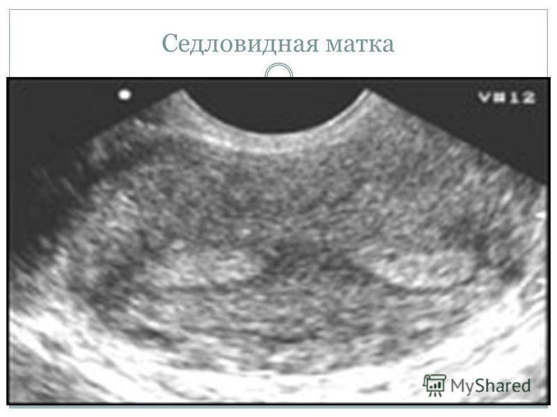 Седловидная матка – возможно ли зачатие и беременность?