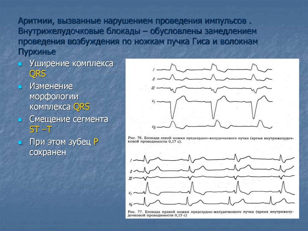 Диагностика и лечение нарушений внутрисердечной проводимости (блокад сердца) в клиническом госпитале на яузе, москва.