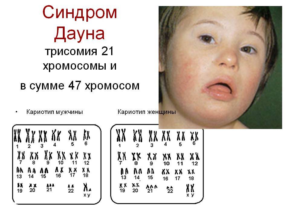 Молекулярно-цитогенетическая диагностика распространенных хромосомных нарушений (анеуплоидий) по 13,16,18,21,22,x,y-хромосом
