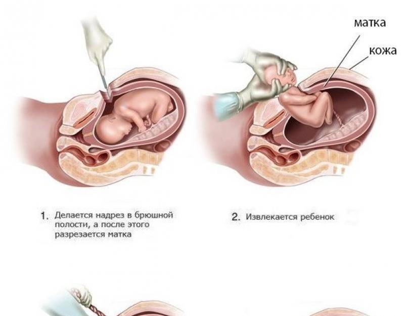 Операция кесарево сечение: плюсы и минусы, показания и