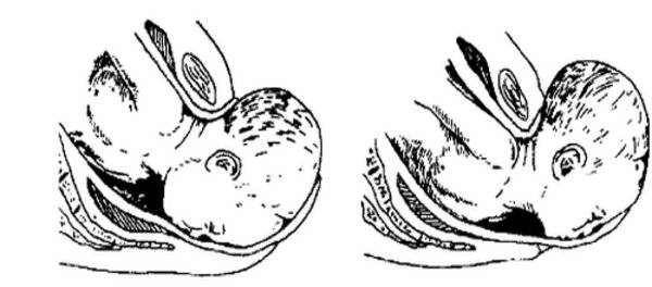 Акушерские щипцы — большая медицинская энциклопедия
