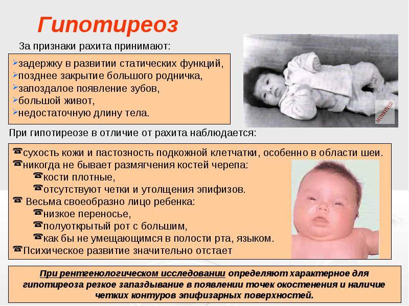 8 характерных симптомов, которые свидетельствуют о врождённом гипотиреозе у младенца