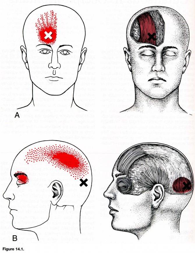 Печет затылок. Области головной боли. Локализация головной боли и причины. Причины головной боли. Головная боль в затылке.