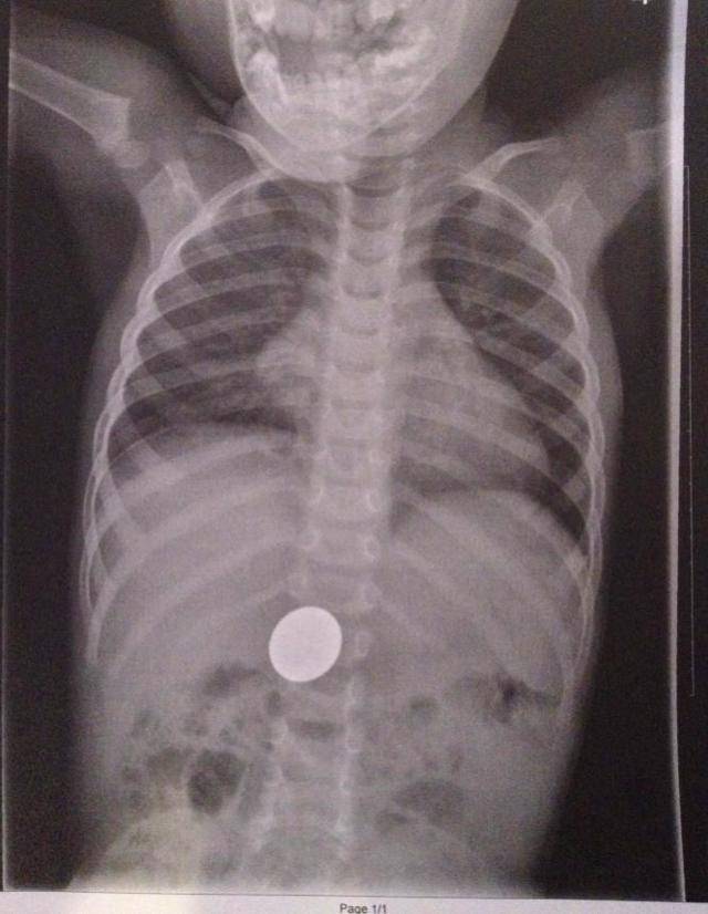 Ребенок проглотил монету что делать комаровский