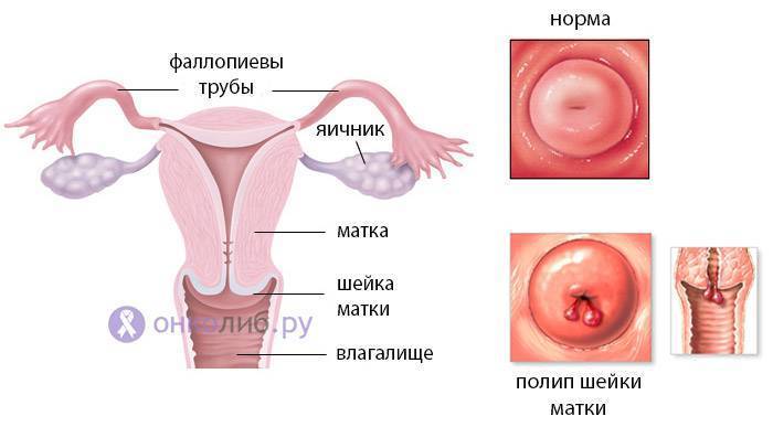 Биопсия шейки матки