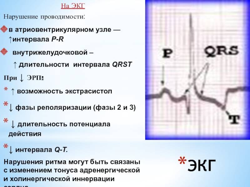 Внутрижелудочковая проводимость. Нарушение внутрижелудочковой проводимости на ЭКГ. Нарушение внутрижелудочковой проводимости на ЭКГ У взрослых. Неспецифические нарушения внутрижелудочковой проводимости на ЭКГ. Синусовая тахикардия нарушение внутрижелудочковой проводимости.