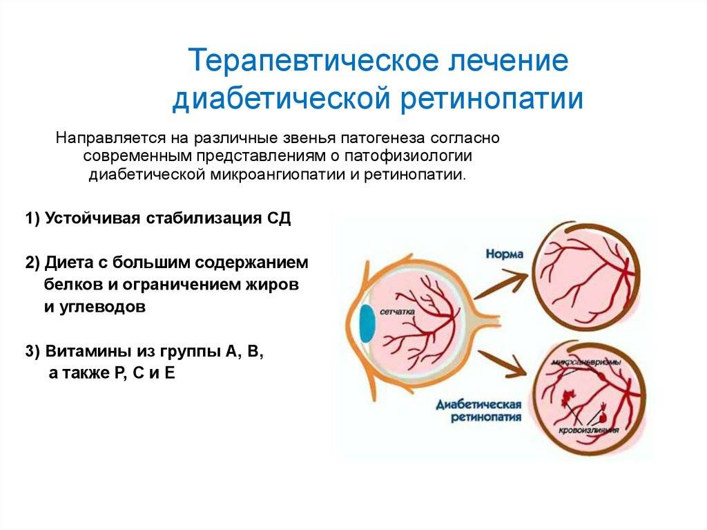 Фоновая ретинопатия: причины и лечение - энциклопедия ochkov.net