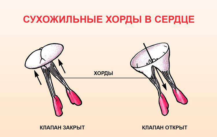 Дополнительная хорда в полости левого желудочка: причины и лечение