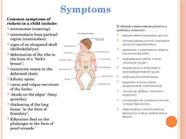 Рахит у детей: симптомы, лечение и профилактика