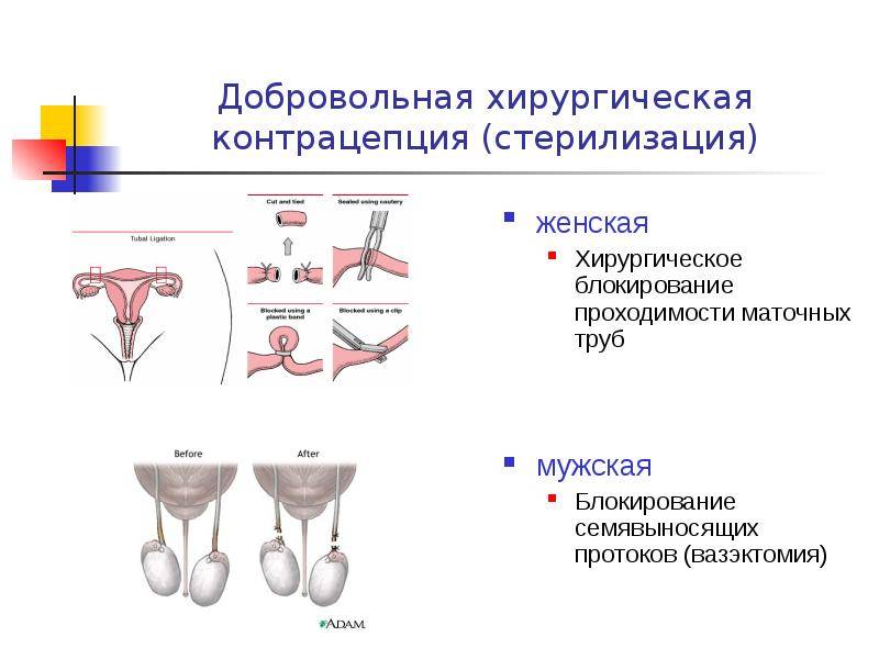 Перевязка маточных труб (женская стерилизация): достоинства и недостатки этого метода контрацепции.
