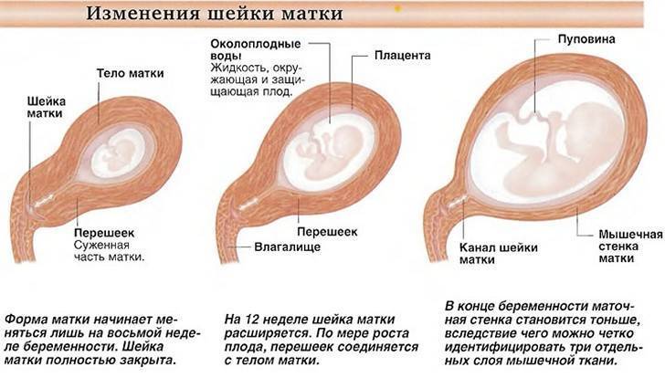 Аденомиоз матки: что это и как лечить?