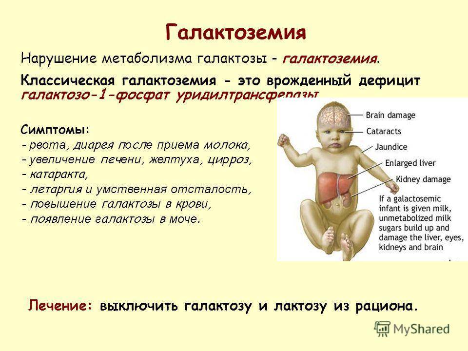 Галактоземия — большая медицинская энциклопедия
